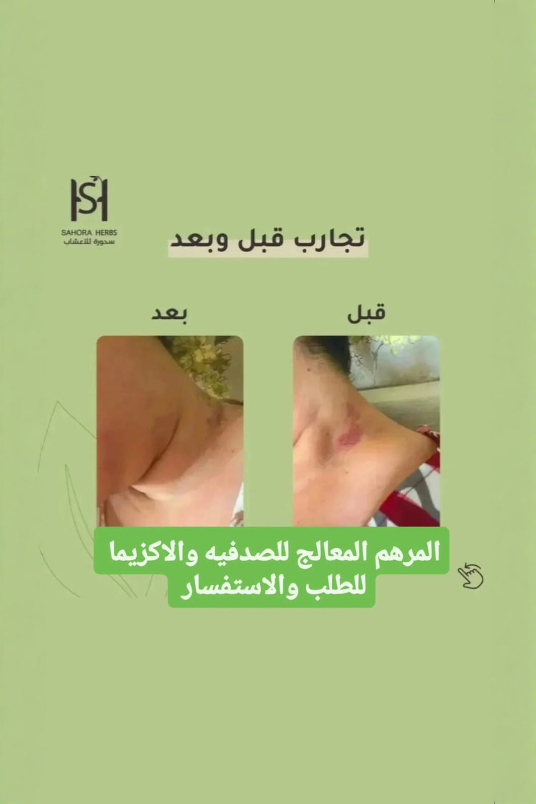 تركيبة مرهم الصدفية والأكزيما